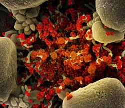 An apoptotic cell (tan) heavily infected with novel coronavirus particles (orange), isolated from a patient sample and viewed through a scanning electron micrograph. - PHOTO PROVIDED BY NATIONAL INSTITUTE OF ALLERGY AND INFECTIOUS DISEASES